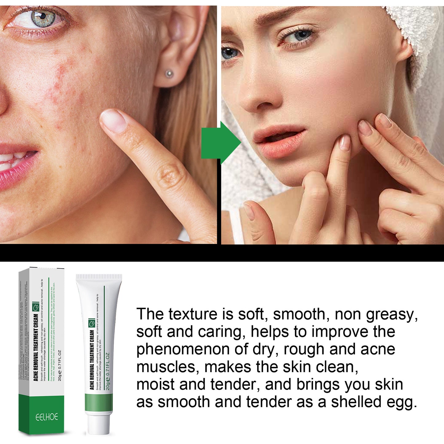 Acne & Blemish Cream Lightens Blemishes & Acne Brightens Skin Complexion Moisturizing Skin Repair Cream