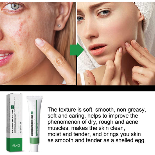 Acne & Blemish Cream Lightens Blemishes & Acne Brightens Skin Complexion Moisturizing Skin Repair Cream
